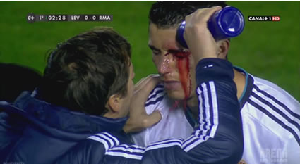 Cristiano Ronaldo Bloody