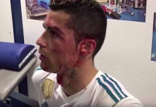 Ronaldo Face Cut Bloody